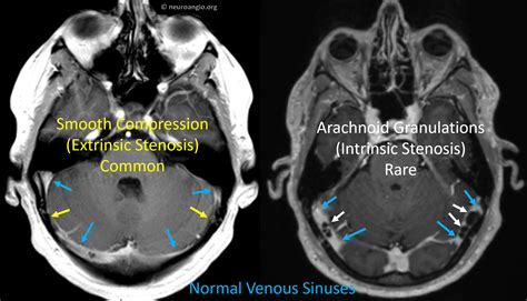 Venous Sinus Stenosis