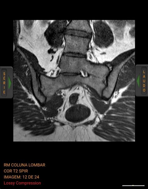lumbosacral transition vertebrae : r/Radiology