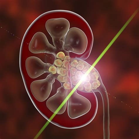 Laser Kidney Stone Procedure at John Wardle blog