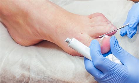 The best toenail fungus treatment for 2026, according to dermatologists Aesthetic