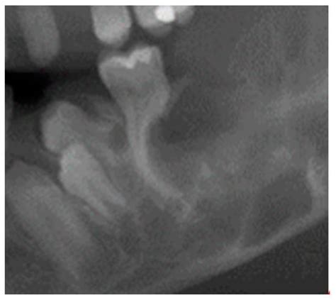 Thoughts on the Etiology of Cherubism