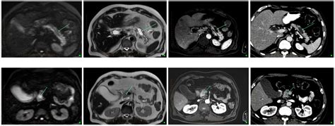 Imaging Modalities for Early Detection of Pancreatic Cancer: Current ...