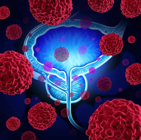 Nivolumab/RT Improves Biochemical Recurrence Outcomes in Prostate Cancer | CancerNetwork