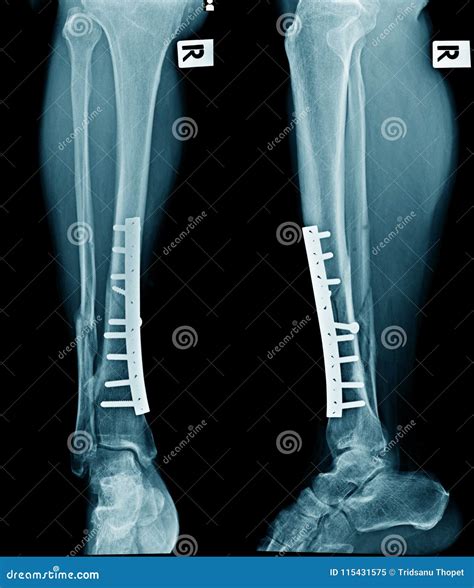 Tibia And Fibula X Ray X Ray Image Of Tibia And Fibula Fracture. AP