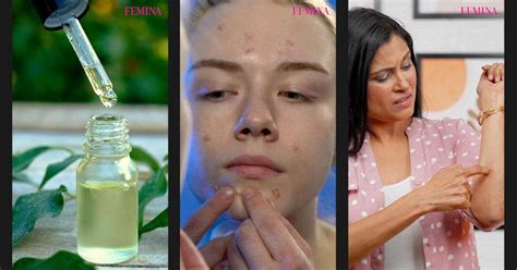 Proven Benefits Of Using Tea Tree Oil For Skin