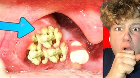 Image result for Loud Exploding Zit