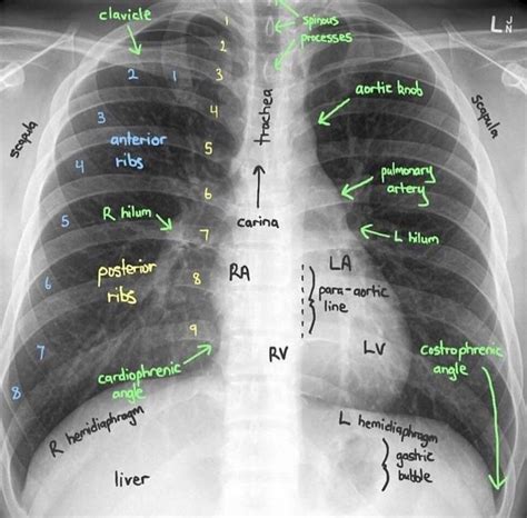 Chest x ray anatomy – Artofit