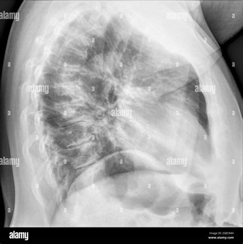 Lateral Chest X Ray Pneumonia Chest X Ray Image View Classification