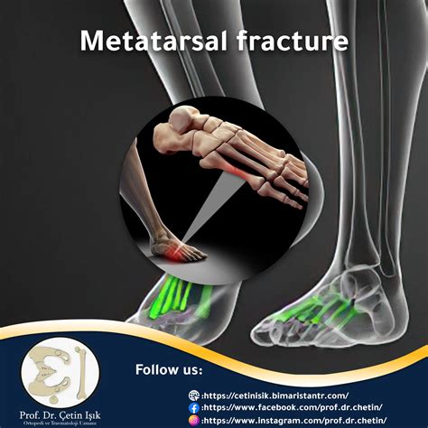 Metatarsal Fracture Swelling