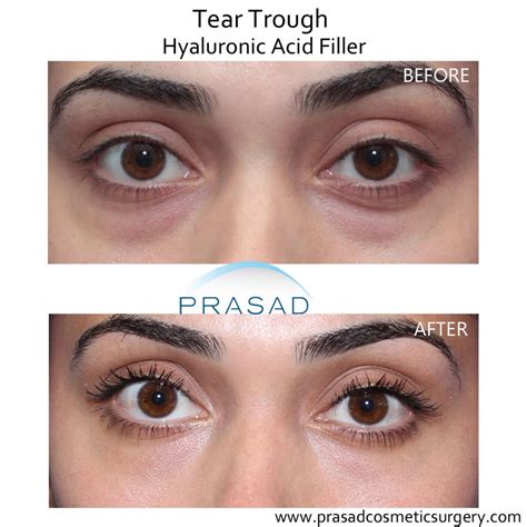 What is the best tear trough filler? | Dr. Prasad Blog