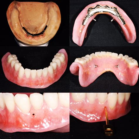 Implant Supported Overdentures in Beverly Hills, CA - Implant Supported Overdentures 90210
