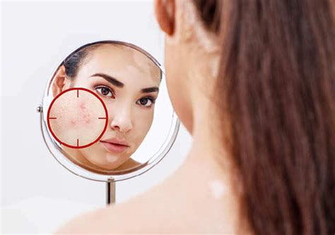 Change in Skincare Needs During Teenage | Femina.in