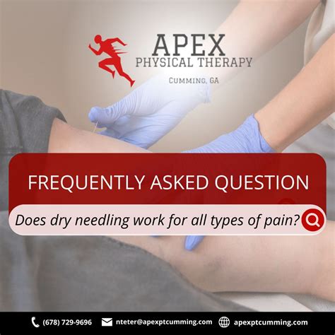 "Does dry needling work for all types of pain?" Dry needling is a powerful and effective ...
