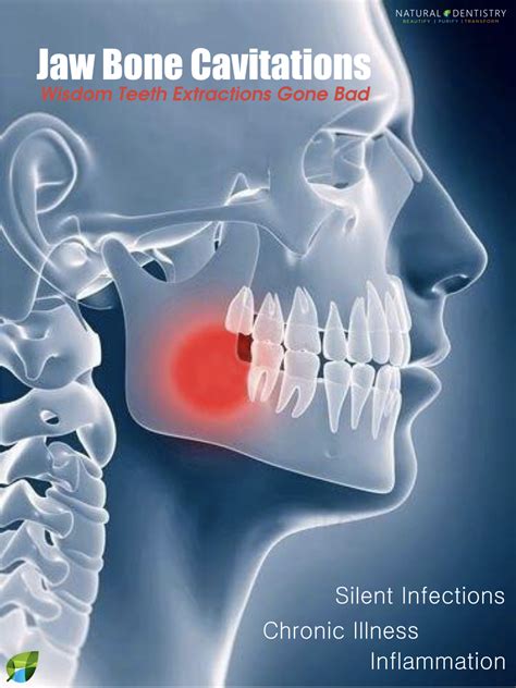 Jaw Bone Infection X Ray at Beth Heard blog