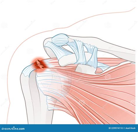 Shoulder Pain. Rotator Cuff Tear Stock Illustration - Illustration of minor, bursae: 229974110