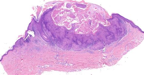Dermatopathology Society of India: Image of the Month