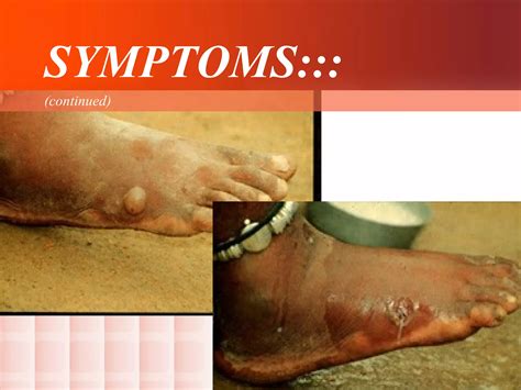 Dracunculiasis (Dracunculus medinensis) (guinea worm disease) | PPT