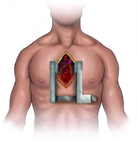 Heart Surgery Types - Open, Bypass, Ablation, Heart Valve surgery