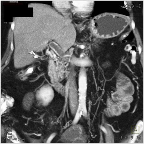 Portal Vein and Superior Mesenteric Vein (SMV) Thrombosis - Vascular Radiology Case Studies ...