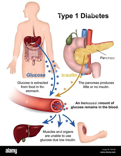 Type 1 Diabetes Diagram Pancreas