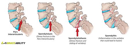 Spondylolysis Vs Spondylolisthesis