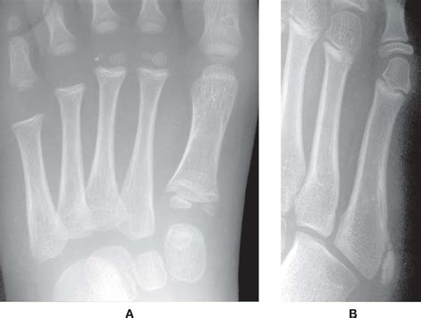 Image result for What iOS a Developmental Variation