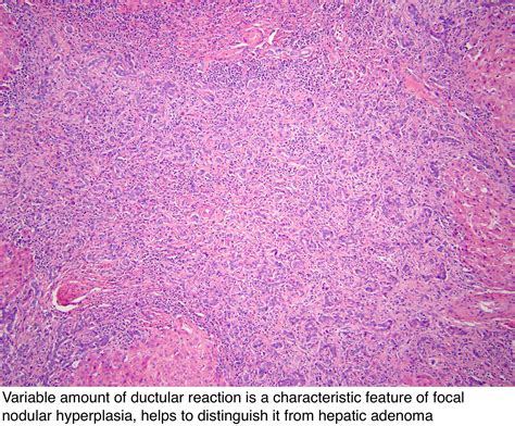 Focal Nodular Hyperplasia Liver