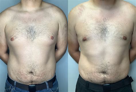 Gynecomastia Before & After Photos | Arroyo Plastic Surgery