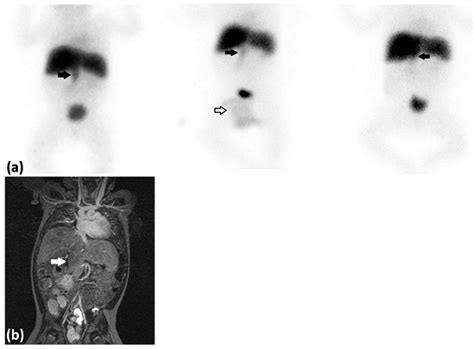 Potential Pitfalls on the 99mTc-Mebrofenin Hepatobiliary Scintigraphy ...