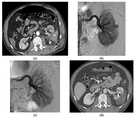 Selective Arterial Embolization of Pseudoaneurysms and Arteriovenous ...