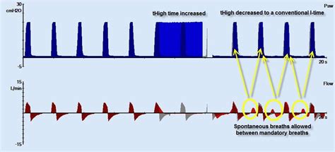 APRV Mode Explained 的图像结果