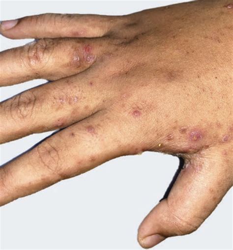 early scabies