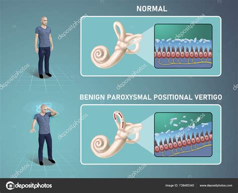 Vértigo Posicional Paroxístico Benigno Vértigo Causado Por Problemas ...