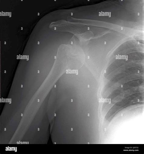 Anterior shoulder dislocation hi-res stock photography and images - Alamy