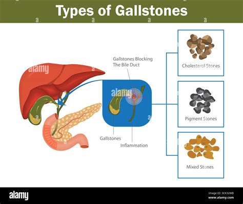 Types of gallstones medical diagram showing cholesterol stones, pigment stones, mixed stones ...