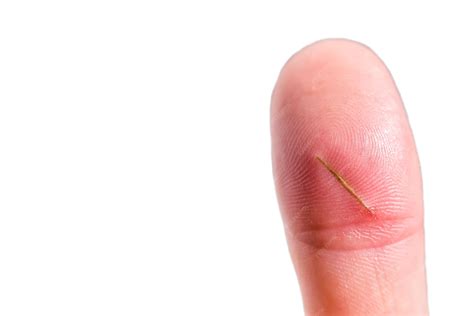 Image result for Hair Splinter Infection