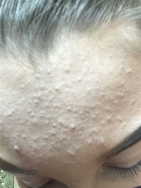 Tiny bumps all over forehead?? – Acne – Acne.org Forum