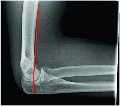 Image result for Elbow Contralateral