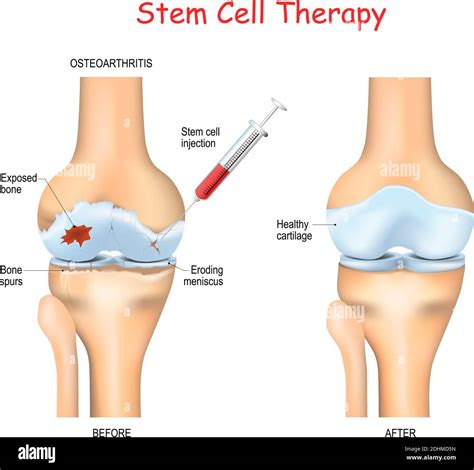 Stem Cell Therapy High Resolution Stock Photography and Images - Alamy