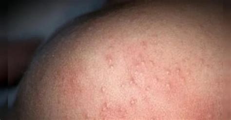 how to get rid of prickly heat : तेज गर्मी और बारिश के बाद की धूप में ...