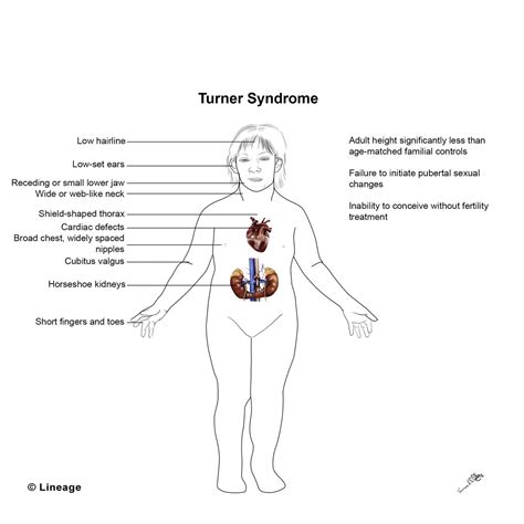 Turner Syndrome - Pediatrics - Medbullets Step 2/3