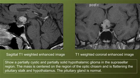 Pituitary gland MRI | PPTX