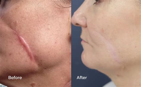 Scar Revision Procedure 的图像结果