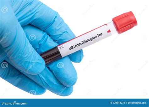 LDH Lactate Dehydrogenase Test Medical Check Up Test Tube with Biological Sample Stock Image ...