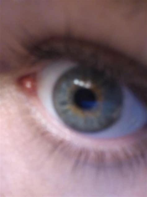 Swollen Caruncle Remedy at Priscilla Scott blog