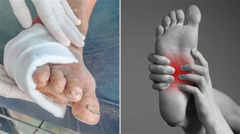 Diabetic Neuropathy: Symptoms, Causes, Risk Factors and Prevention | Sprint Medical