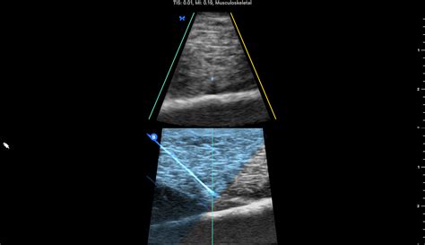 Butterfly POCUS systems · GD Medical