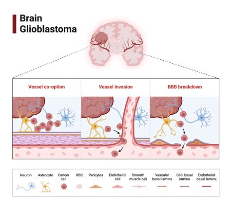 Brain Glioblastoma | BioRender Science Templates