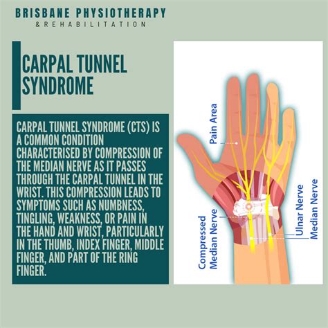 Carpal Tunnel Syndrome Causes How To Treat Carpal Tunnel Oviedo
