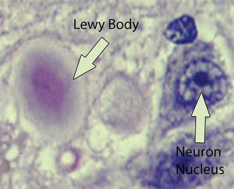 What is Lewy Body Dementia - Causes, Symptoms, Diagnosis, Treatments